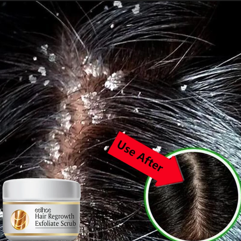 Scalp Scrub Exfoliant - علاج سريع مضاد للقشرة للشعر، مقشر