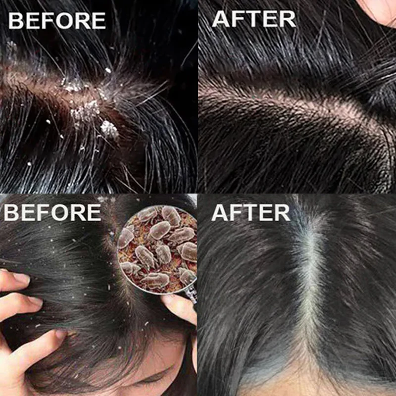 علاج سريع مضاد للقشرة للشعر، م - مراجعة Scalp Scrub Exfoliant وسعره