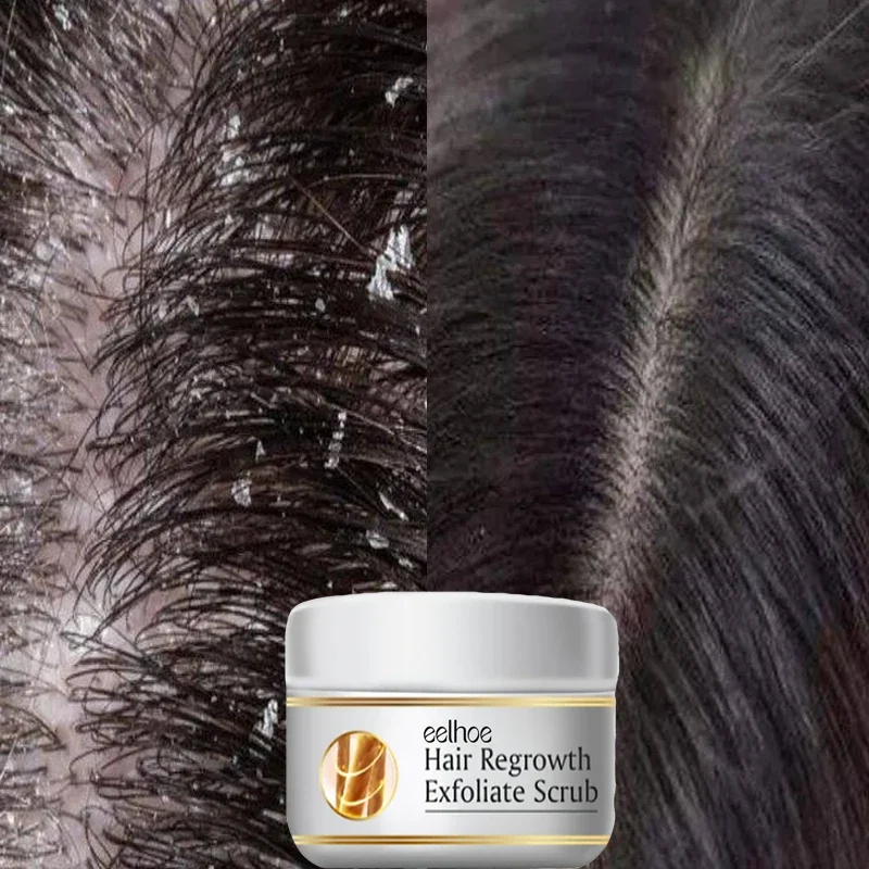 علاج سريع مضاد للقشرة للشعر، م - مراجعة Scalp Scrub Exfoliant وسعره
