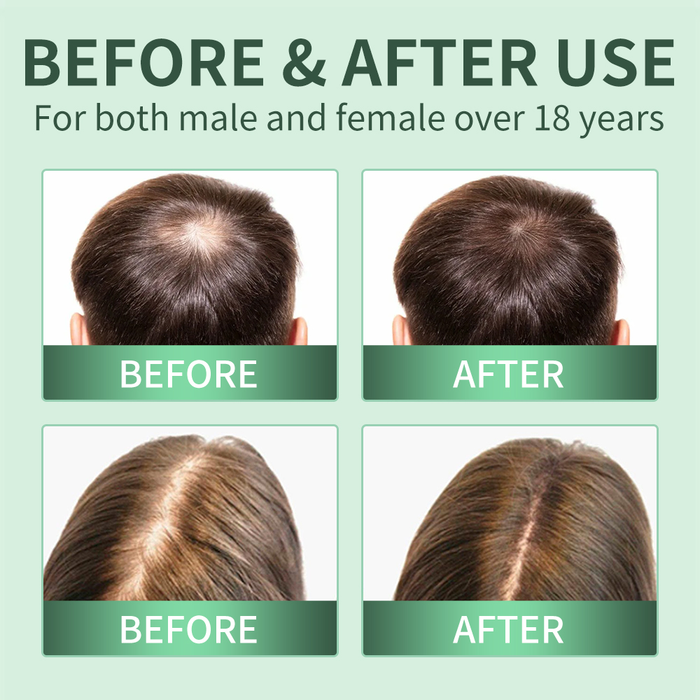 بخاخ لنمو الشعر، مقشر لفروة ال - مراجعة Scalp Scrub Exfoliant وسعره